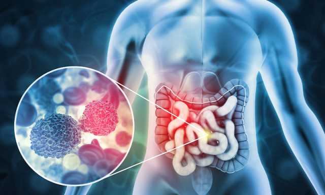 پاکستانی نوجوانوں میں بڑی آنت کے کینسر کی کیا وجوہات ہیں؟