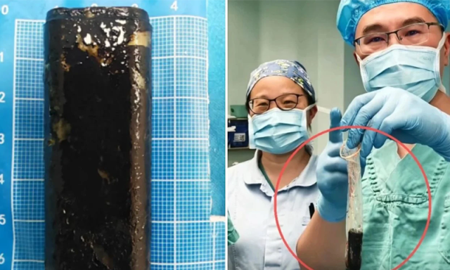 کنڈوم کی مدد سے معدے سے لائٹر نکالنے کا انوکھا طبی عمل