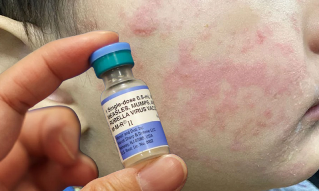 جنوبی کیرولائنا میں خسرے کی وبا میں تیزی، کم ویکسینیشن شرح پرتشویش