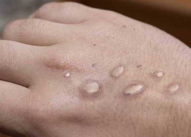 منکی پاکس پھیلاو کے خدشات، ضلع خیبر میں اسمارٹ لاک ڈاون نافذ