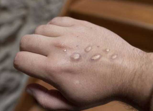 کراچی :منکی پاکس کا مشتبہ کیس سامنے آگیا