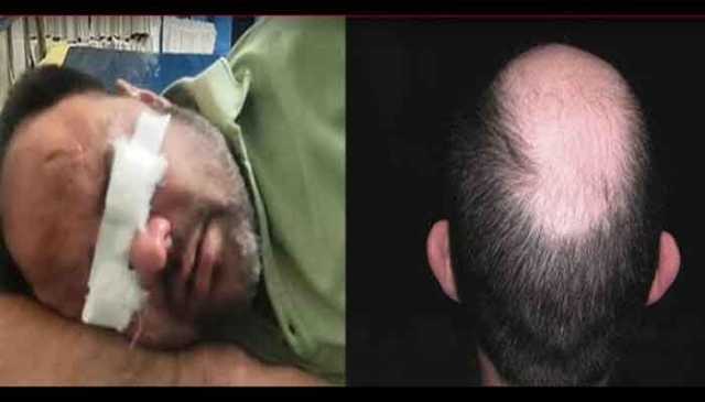 گنج پن سے بچنے کا تیل استعمال کرنے پر 200 افراد کی آنکھیں متاثر