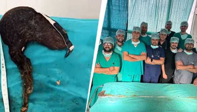 7 سالہ بچے کے معدے سے بال، گھاس اور جوتے کے تسمے کا گچھا نکال لیا گیا