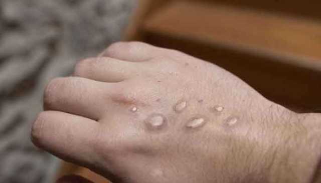 کراچی میں منکی پاکس کا پہلا مشتبہ کیس سامنے آگیا