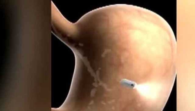 ٹیسٹ کی جھنجھٹ ختم، معدے کے معائنے کے لئے،، اے آئی کیپسول تیار ،،