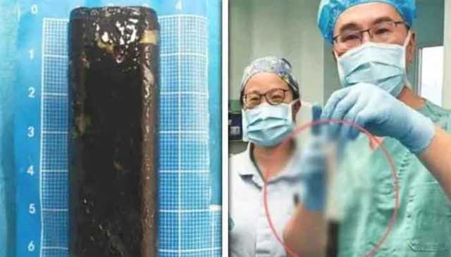 30 سال بعد مریض کے معدے سے لائٹر برآمد، ڈاکٹر بھی حیران