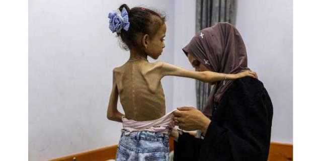 غزہ: قحط نما کیفیت میں ہلاکتوں اور بیماریوں میں اضافہ